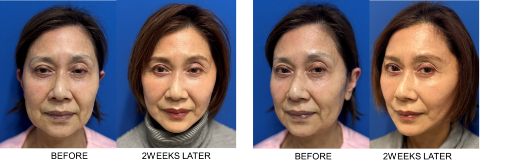 70代の女性のクイックチタンペックリフトのビフォーアフター