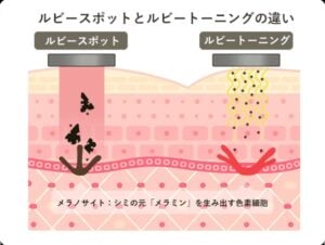 ルビートーニングとルビースポットの違い
