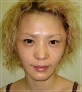 手術直後の患者