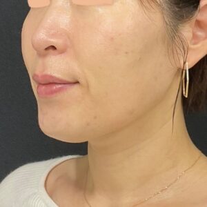 ボルニューマ（右・施術後）
