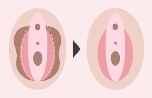 小陰唇縮小術の効果を表すイラスト