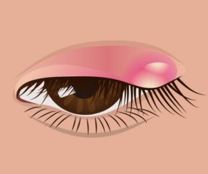 霰粒腫のイラスト