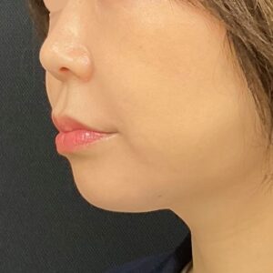ボルニューマ＋ハイフ（左・施術後）