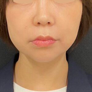 ボルニューマ＋ハイフ（正面・施術後）
