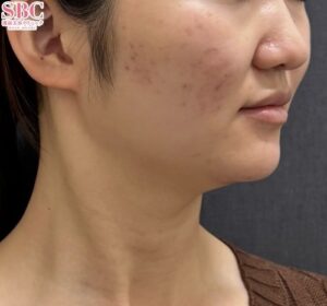 オンダリフトを受る前の女性（ビフォー）