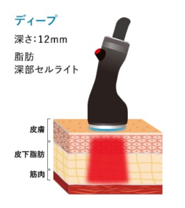 ボディ用ハンドピース照射イメージ