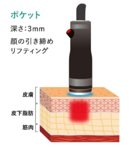顔用ハンドピース照射イメージ