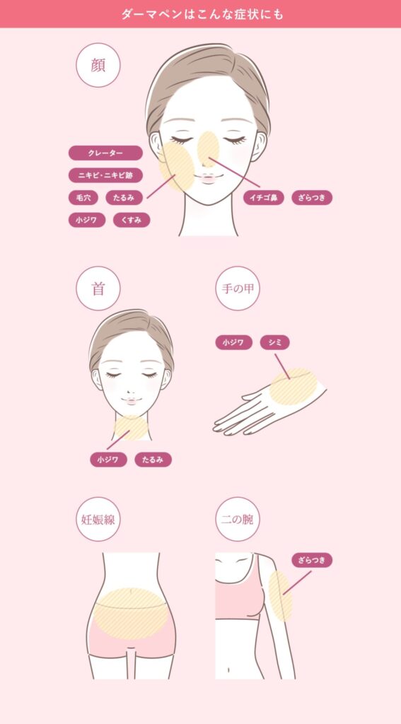 ダーマペン４の治療範囲