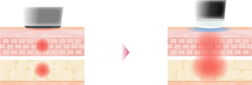 オンダリフトの効果のメカニズム