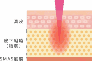 ボルニューマの皮膚組織への加熱イメージ