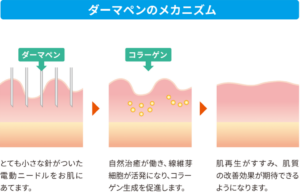 ダーマペンで効果がでるメカニズム
