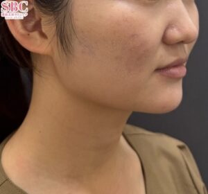 オンダリフトを受けた女性（アフター）