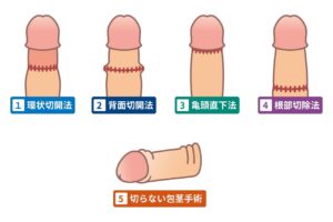 包茎手術の種類