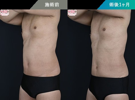オンダリフトを受けた男性のビフォーアフター
