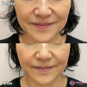 まゆりなclinic名古屋栄のオリジオKISSの症例
