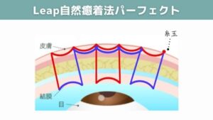 Leap自然癒着法パーフェクトの図