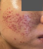 施術2日目の写真