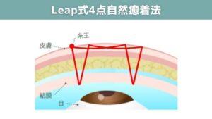  Leap式4点自然癒着法の図
