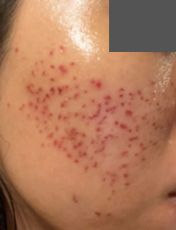 施術3日目の写真