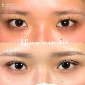 二重埋没法のビフォーアフター