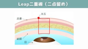 Leap二重術（二点留め）の図