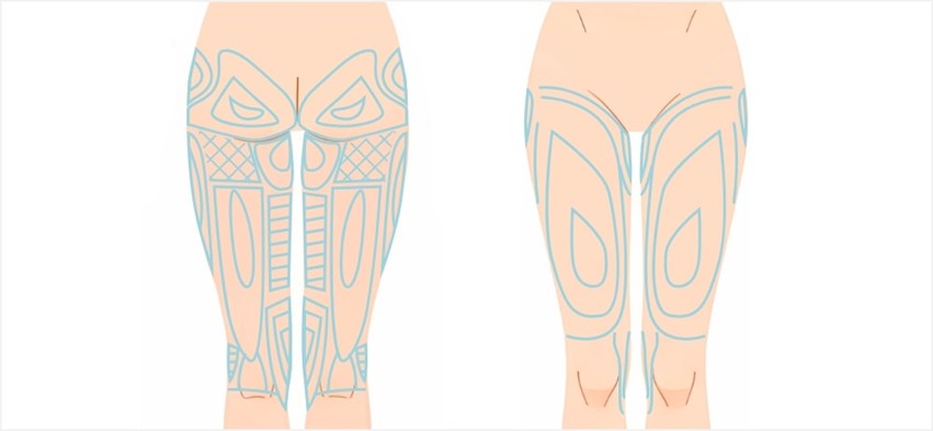 太もも脂肪吸引のデザイン
