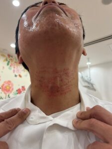 キュアジェット施術後の富本