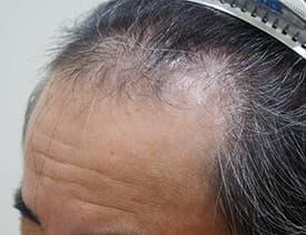 前頭部の薄毛の施術