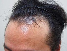 M字等の生え際 i-SAFEによる施術