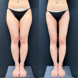 太もも脂肪吸引のビフォーアフター（前）