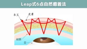 Leap式6点自然癒着法の図