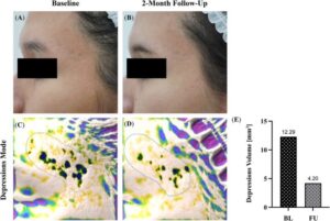 肌再生・瘢痕治療への拡張応用の画像