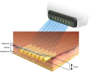ソフウェーブのメカニズム