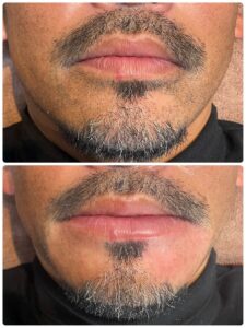 40代男性の針脱毛のビフォーアフター