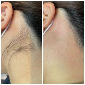 30代女性の針脱毛のビフォーアフター