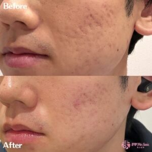 キュアジェットのコンタクトモードのビフォーアフター