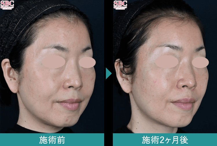 デンシティの症例2のビフォーアフター