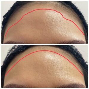 40代女性の針脱毛のビフォーアフター