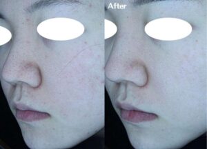 キュアジェットのトーニングモードのビフォーアフター