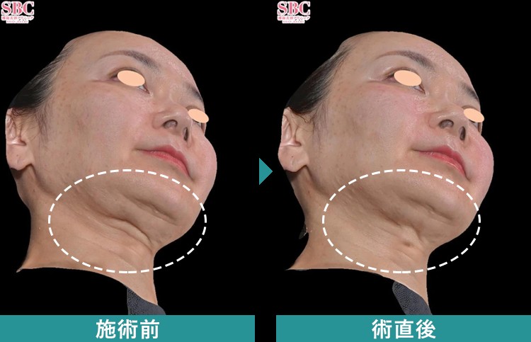 デンシティの症例3のビフォーアフター