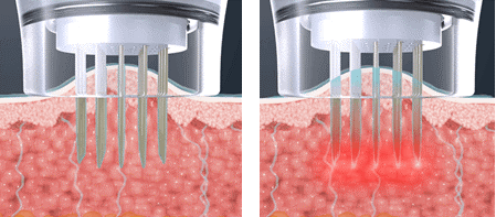 ポテンツァの針がRFを届ける様子