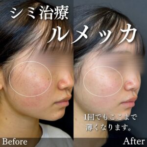 ルラ美容クリニックのシミ症例のビフォーアフター