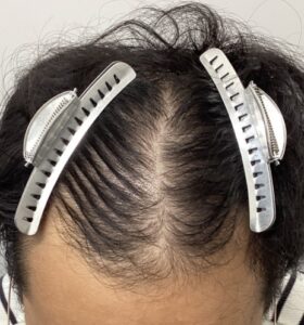 ビフォー：頭頂部