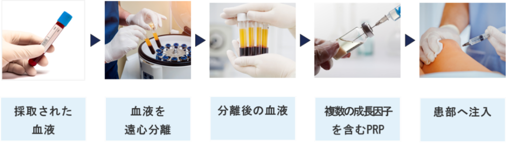 PRP療法のプロセス