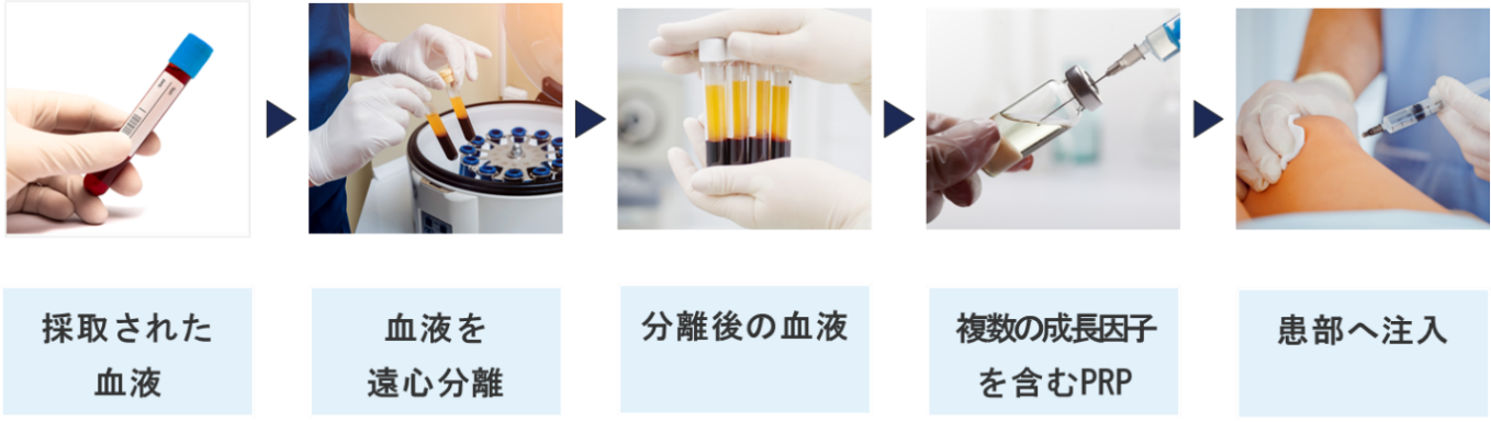PRP療法のプロセス