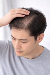 初期のAGAの男性