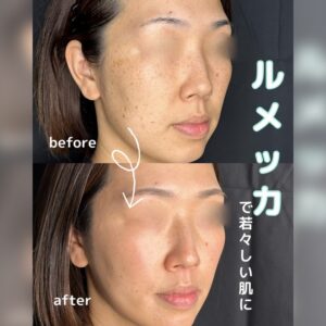 ルラ美容クリニックのエイジングケア治療のビフォーアフター