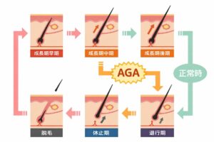 AGAのメカニズム