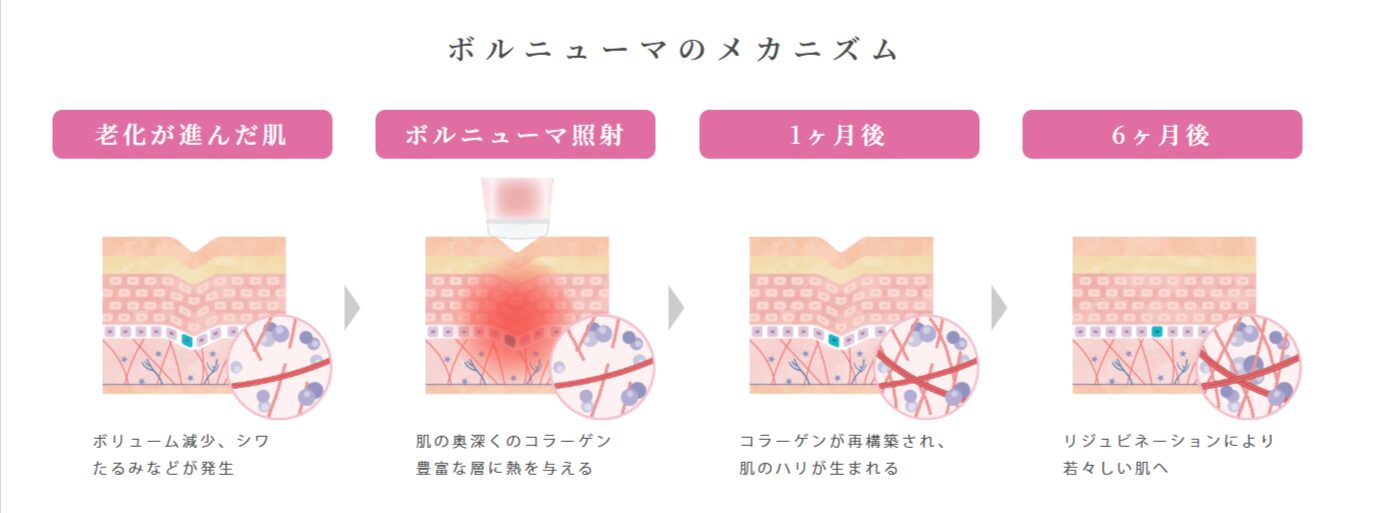 ボルニューマのメカニズム