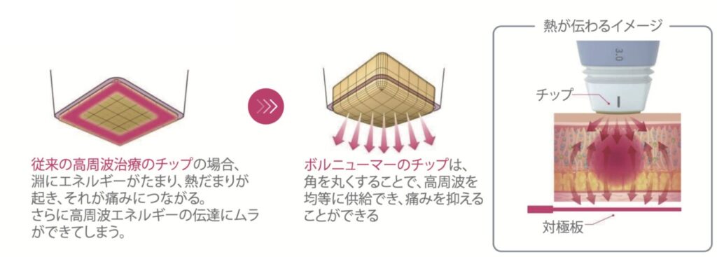 ボルニューマのチップ